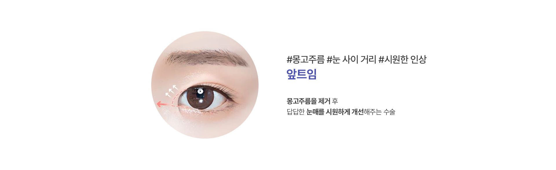 뒤트임