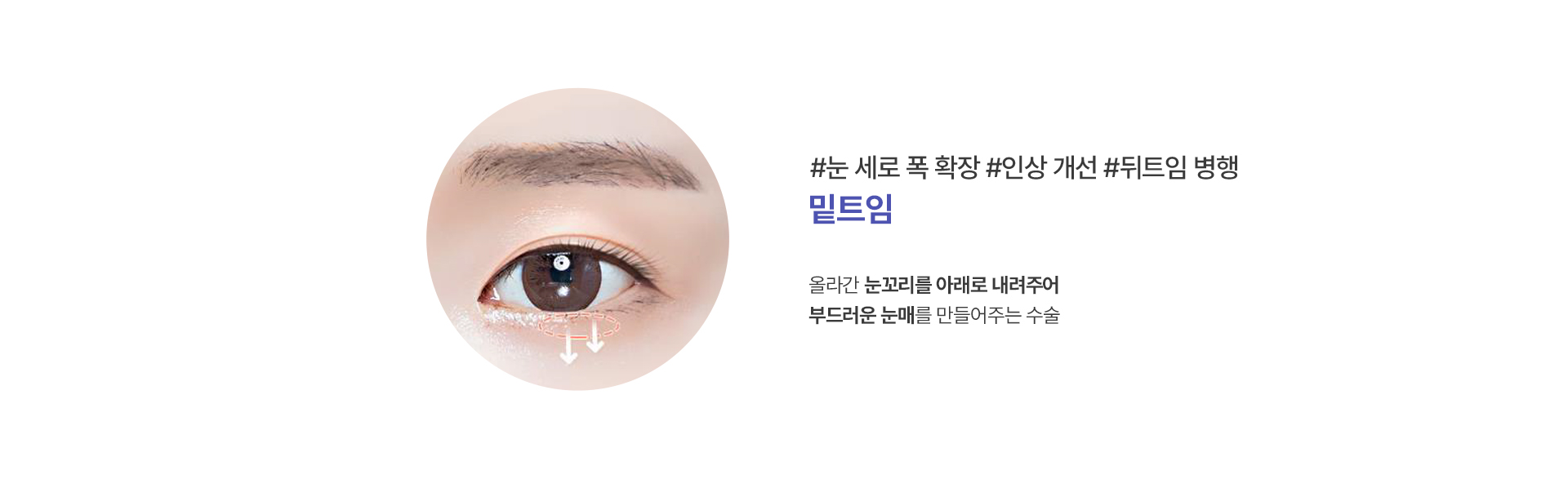 밑트임