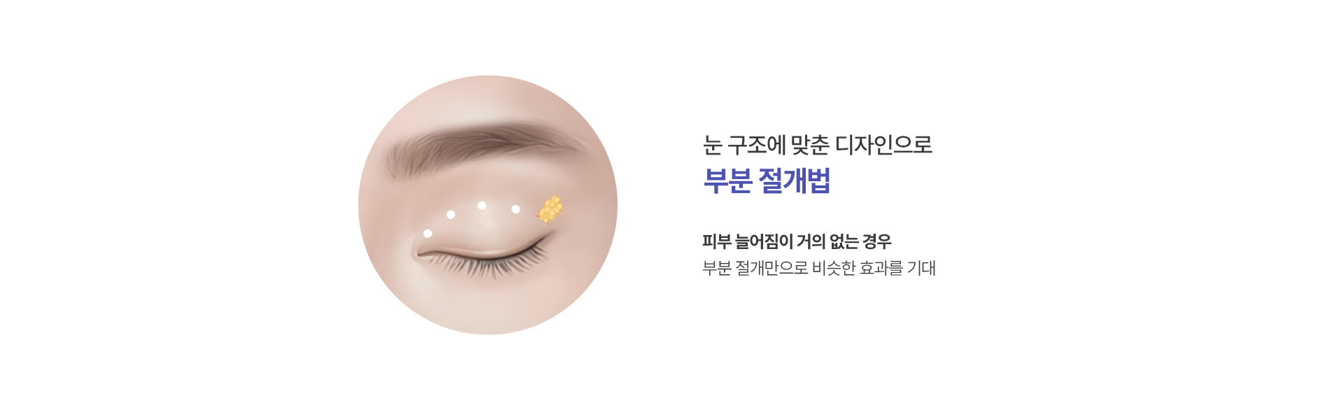 부분 절개법