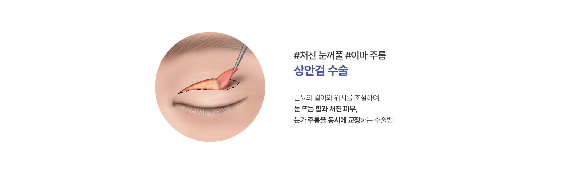 상안검 수술