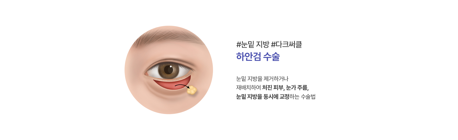 하안검 수술