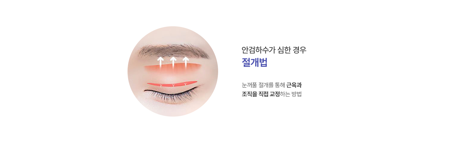 절개법