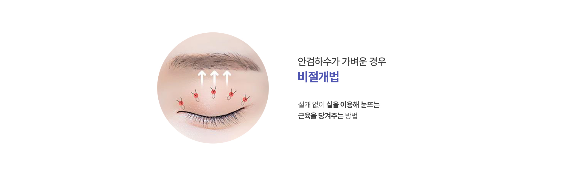 비절개법