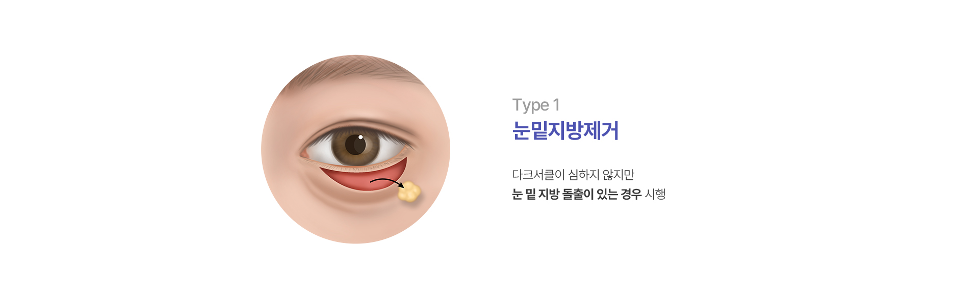 눈밑지방제거
