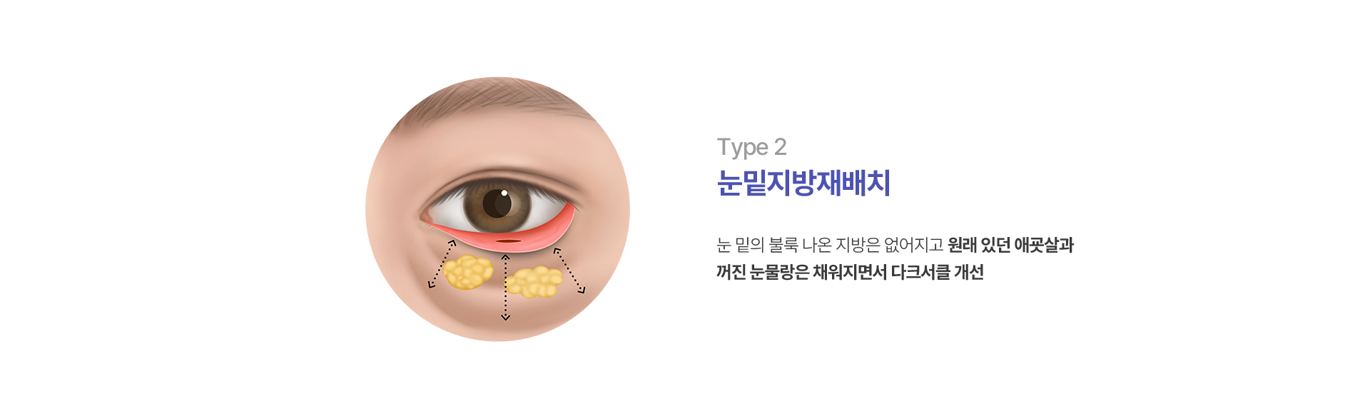 눈밑지방재배치