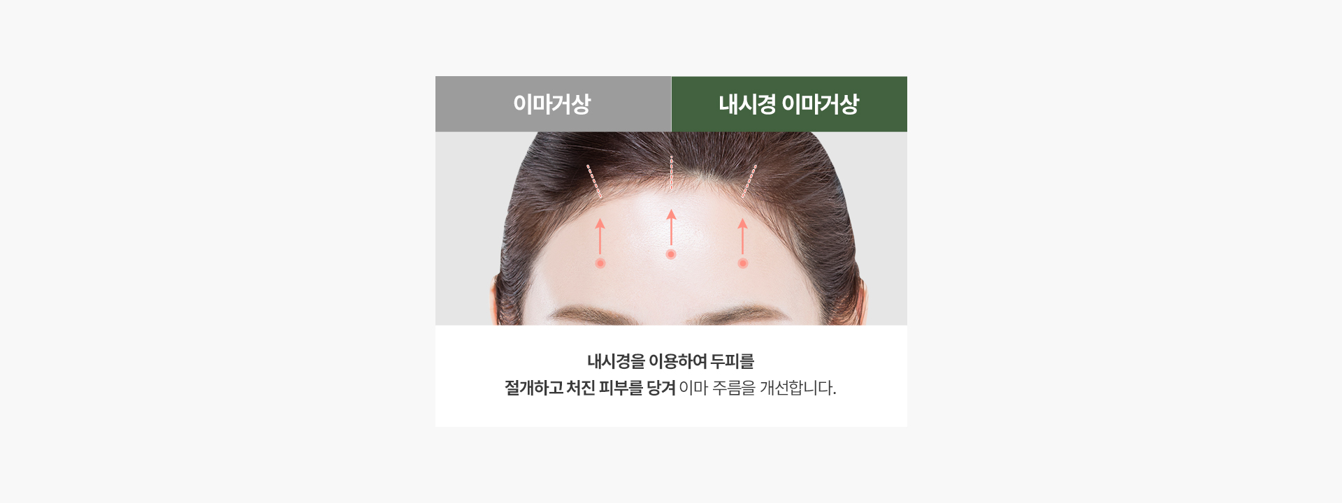 내시경 이마거상