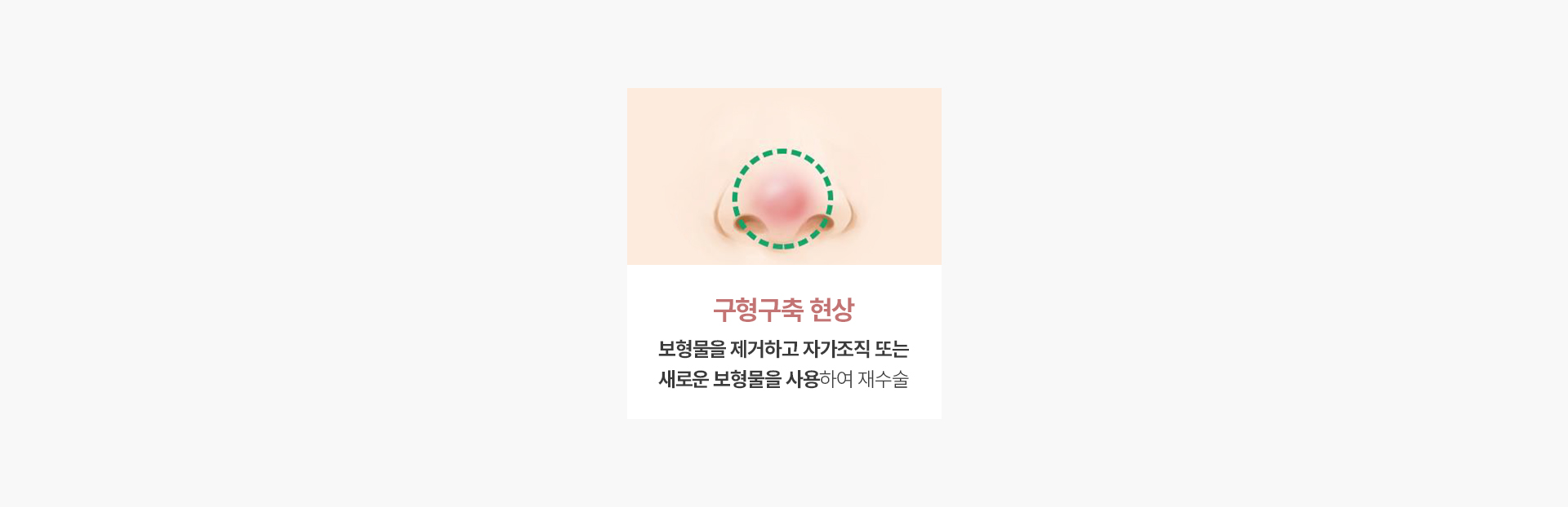 구형구축 현상