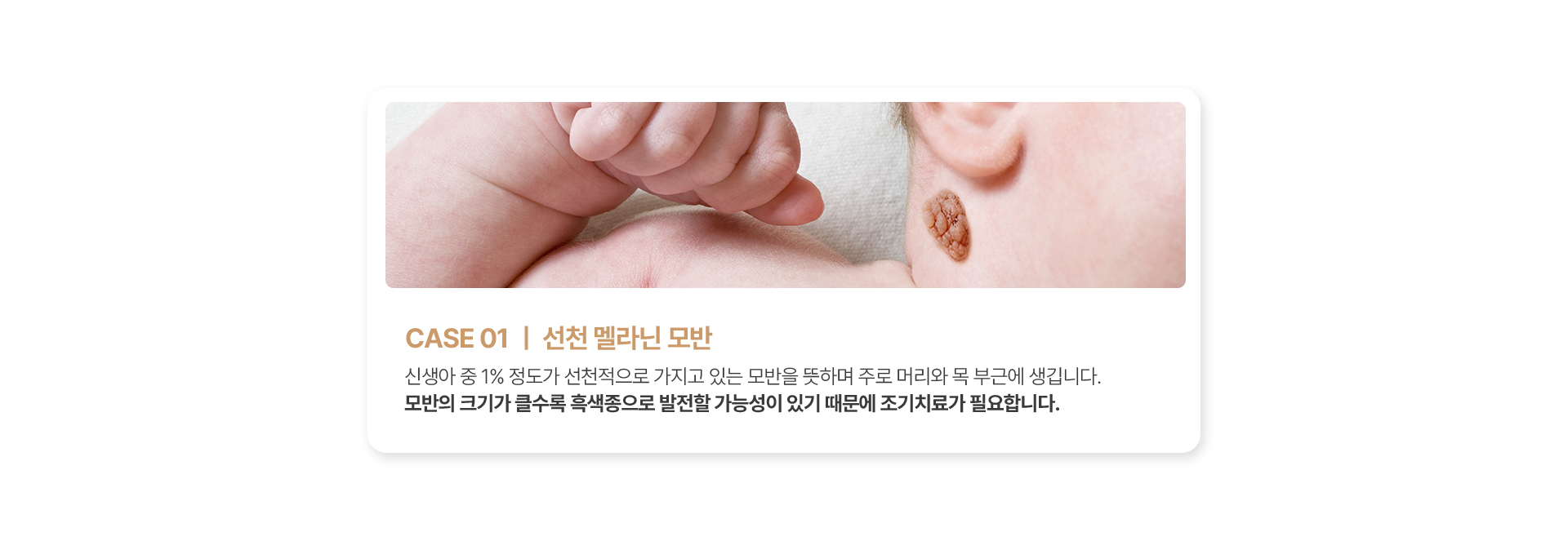선천 멜라닌 모반