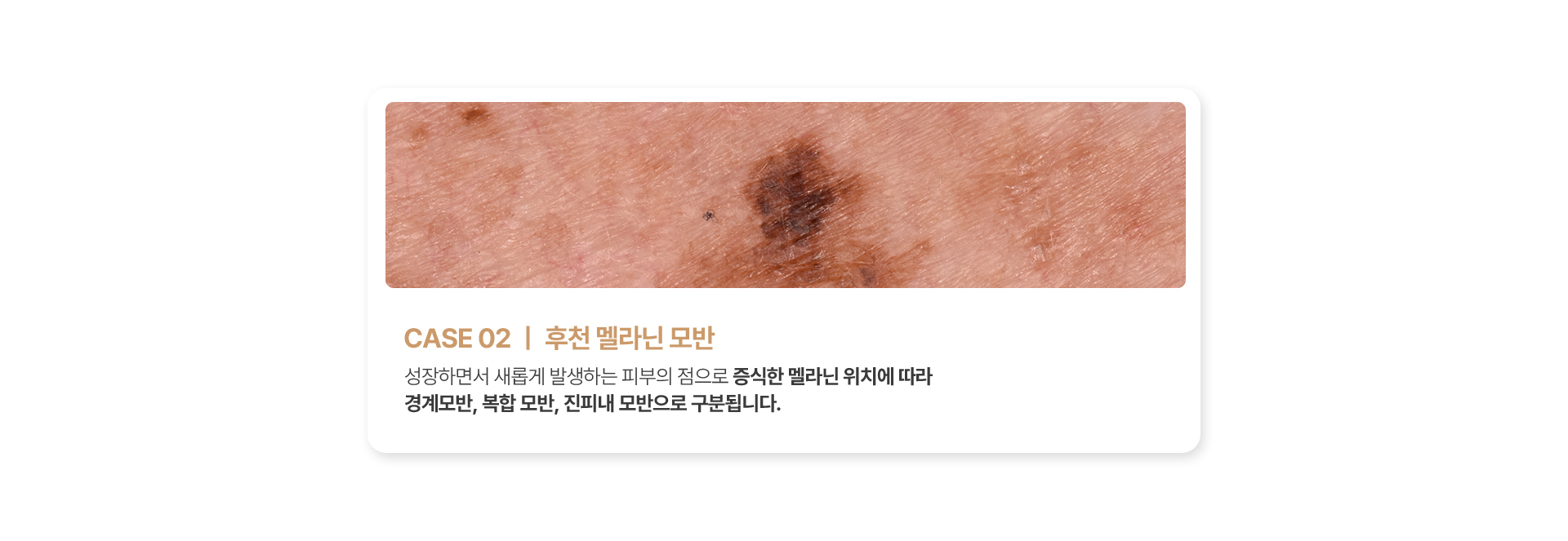 후천 멜라닌 모반