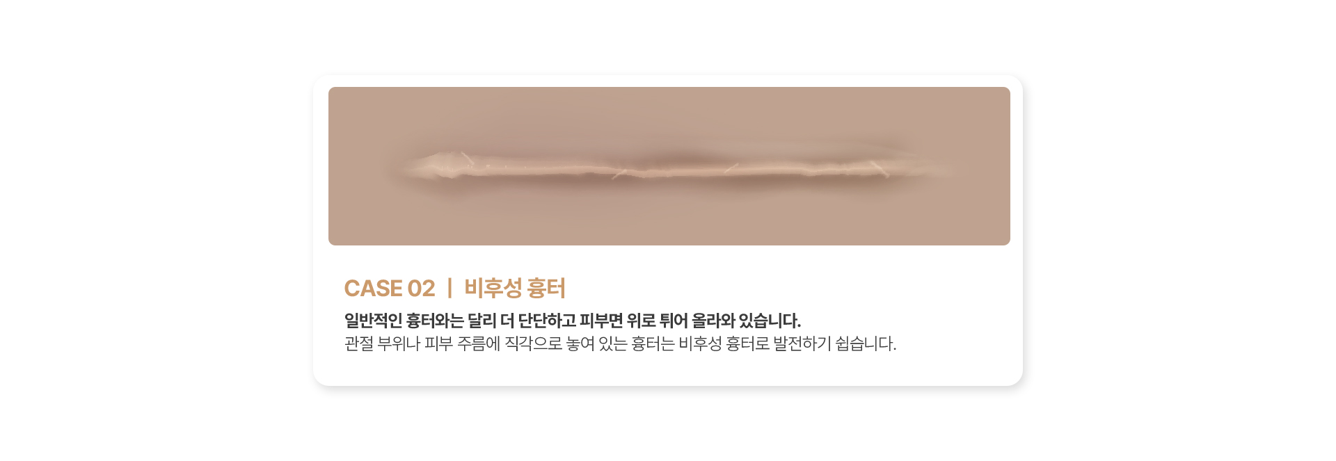 비후성 흉터