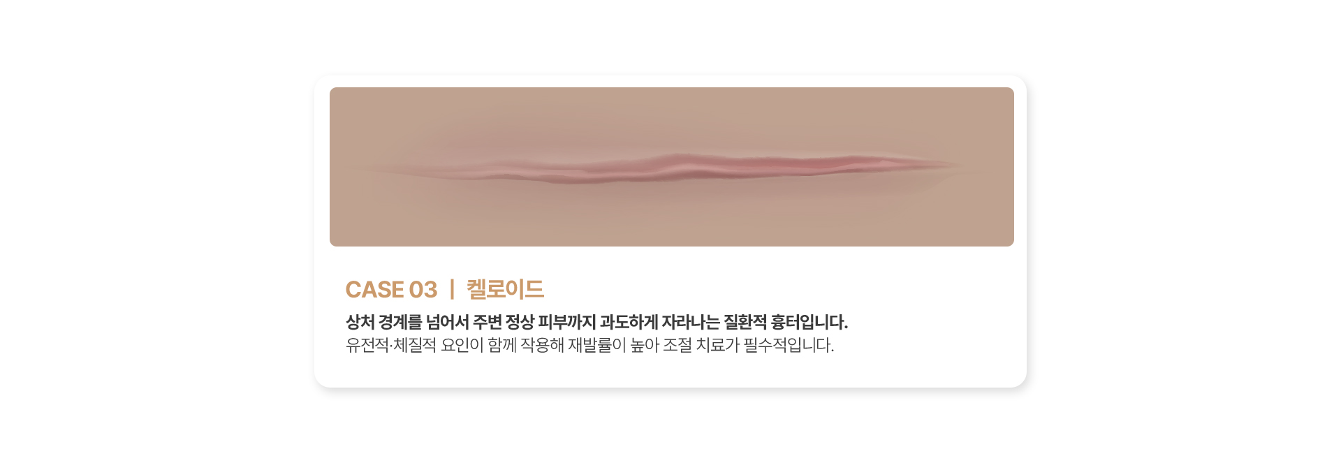 켈로이드