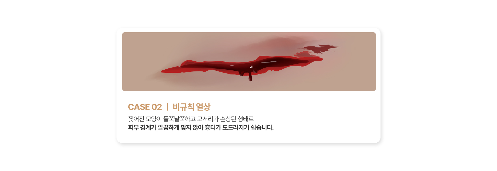 비규칙 열상