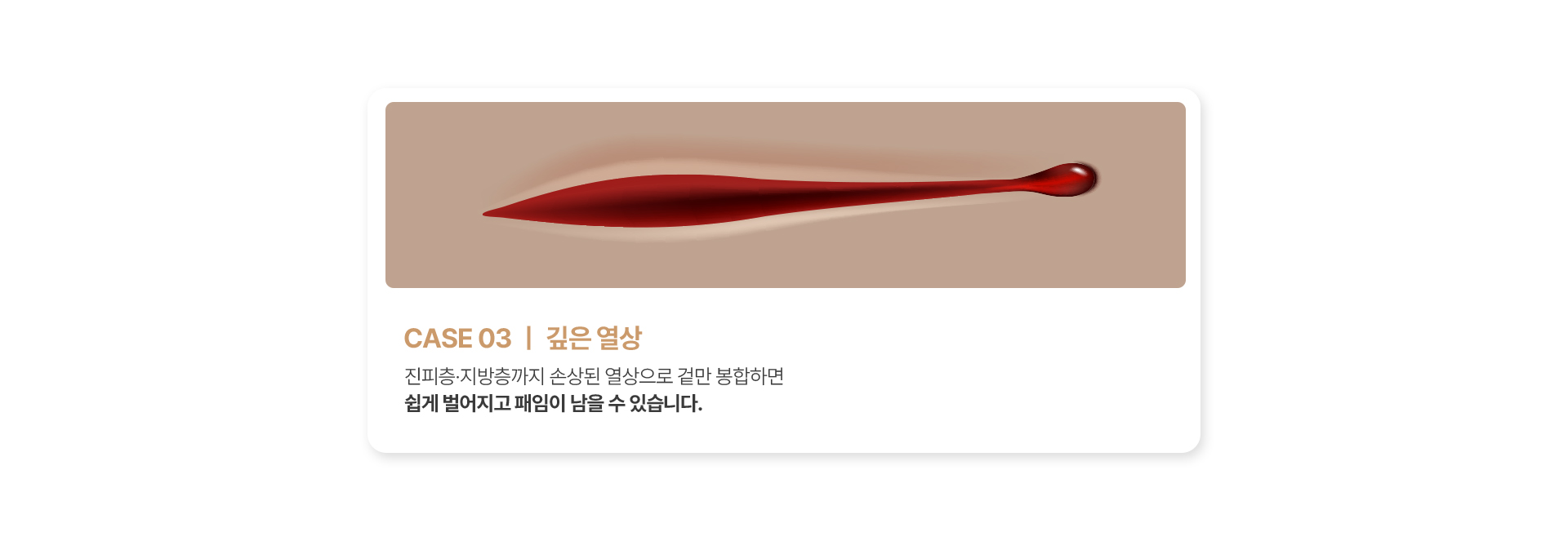 깊은 열상