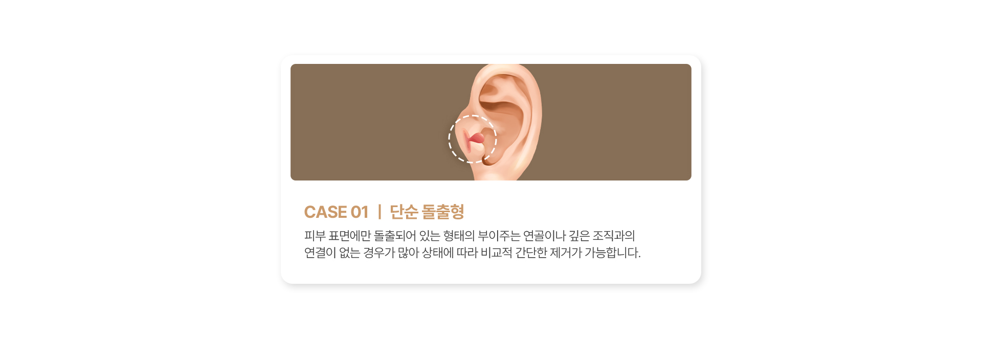 단순 돌출형