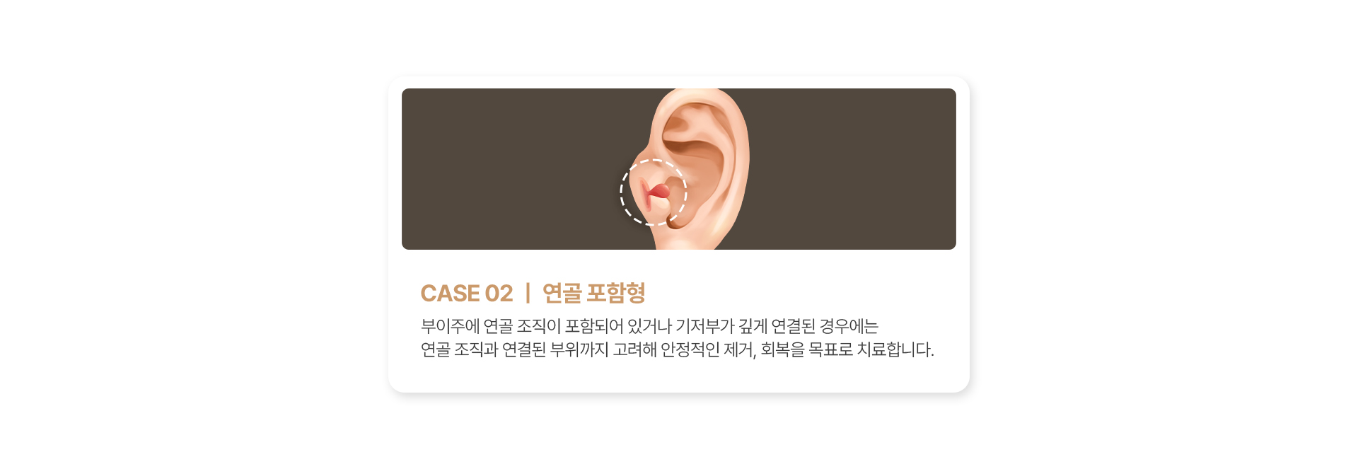 연골 포함형