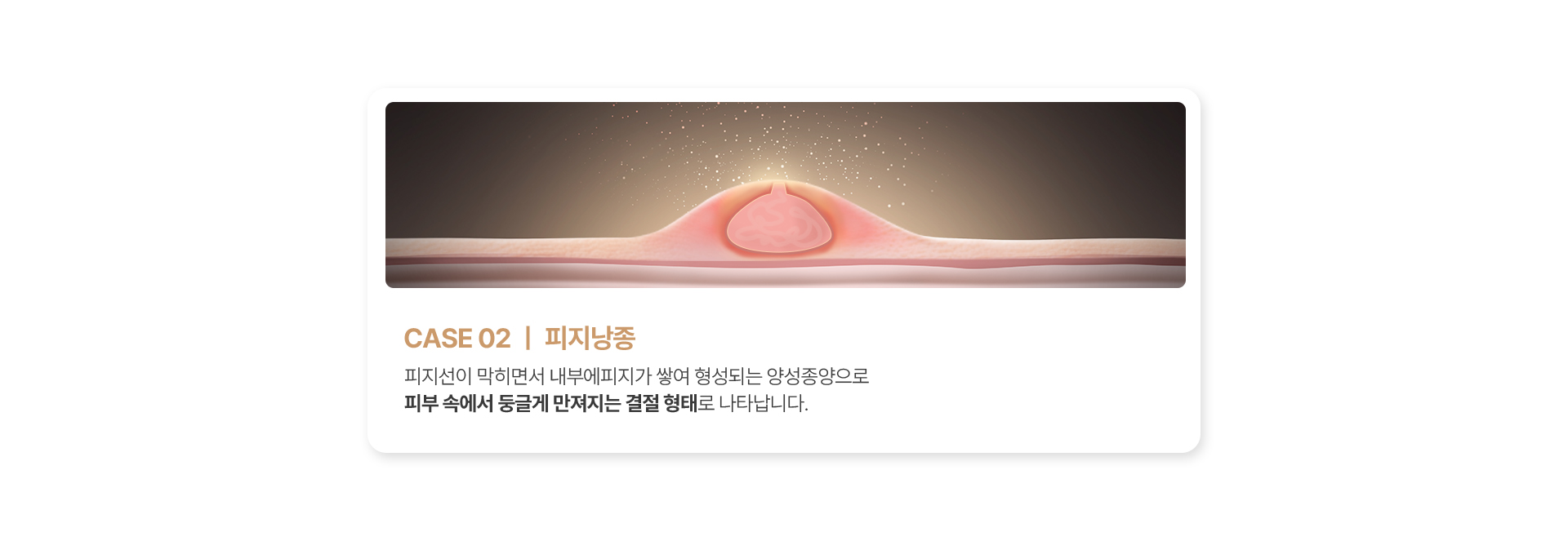 피지낭종