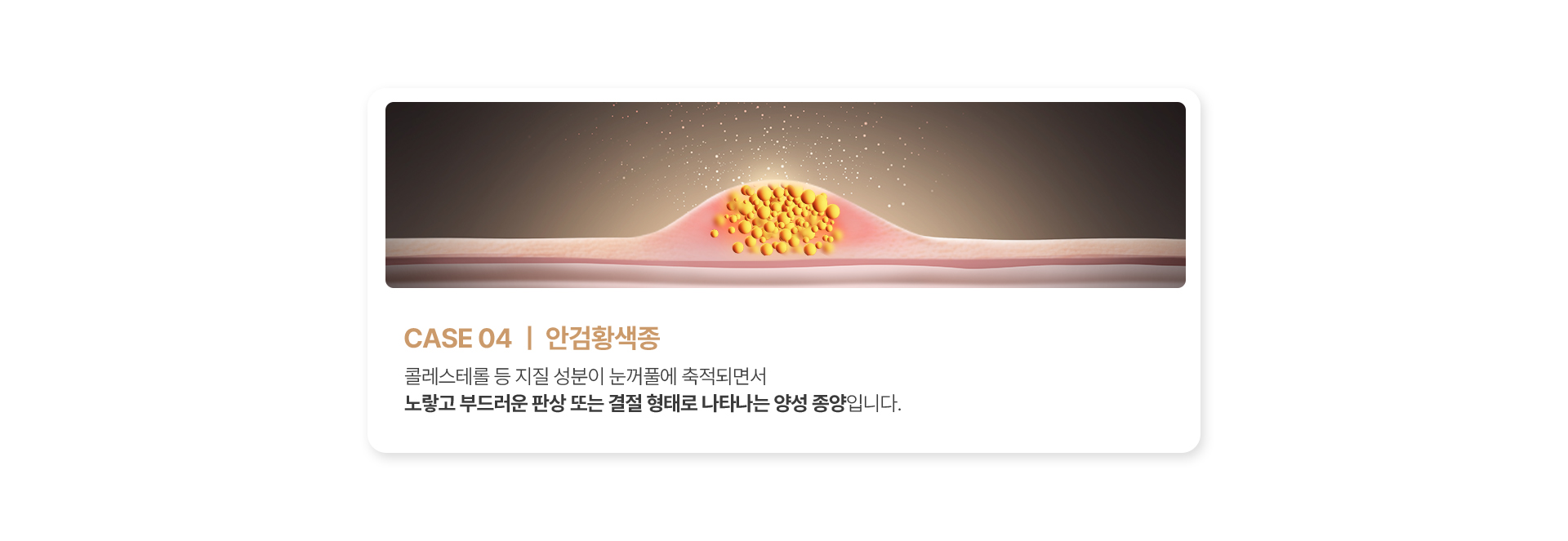 안검황색종